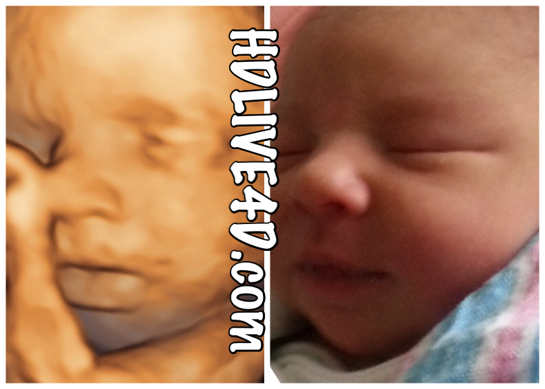 Before & After Photo Gallery - 5D HDLive™ | 3D 4D HD Ultrasound Virginia