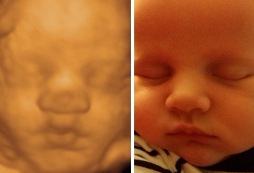 does hair show up on 3d ultrasound