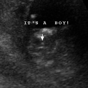 Weeks 13 ultrasound gender at Gender at