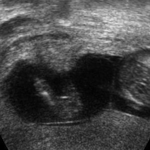 Weeks 13 ultrasound gender at How to