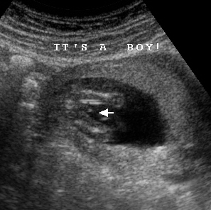 Its A Boy Ultrasound 14 Weeks