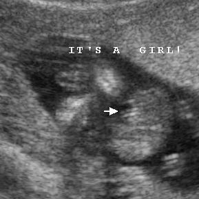Early Gender Girls 15 Weeks | 3D 4D HD Ultrasound Virginia
