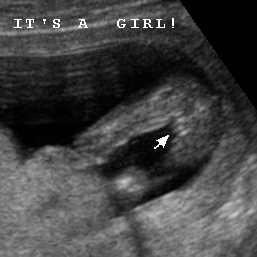 Early Gender Girls 15 Weeks | 3D 4D HD Ultrasound Virginia