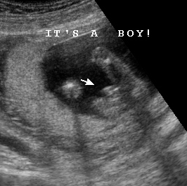 Early Gender Boys 15 Weeks | 3D 4D HD Ultrasound Virginia