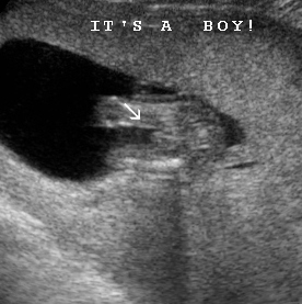 Early Gender Boys 15 Weeks | 3D 4D HD Ultrasound Virginia