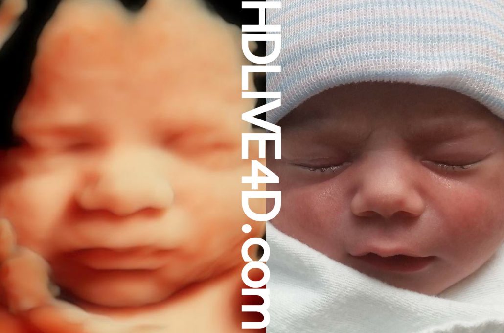 Before & After Photo Gallery – 5D HDLive™ | 3D 4D HD Ultrasound Virginia